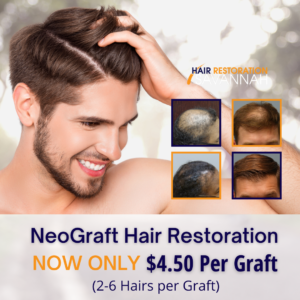 NeoGraft hair restoration only $4.50 per graft at Hair Restoration Savannah