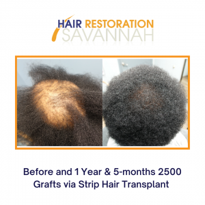 Before and after Strip Hair Transplantation for women