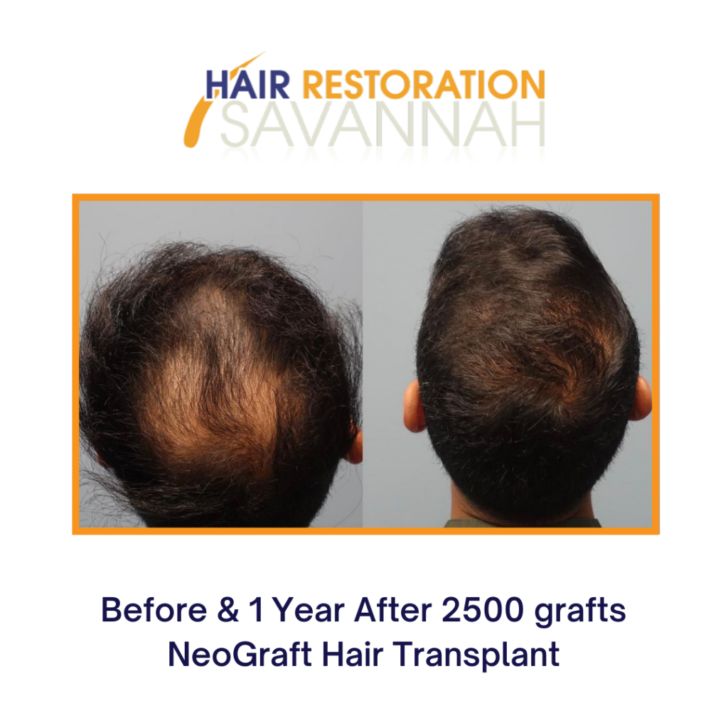 Before and after 1 year Neograft 2500 grafts