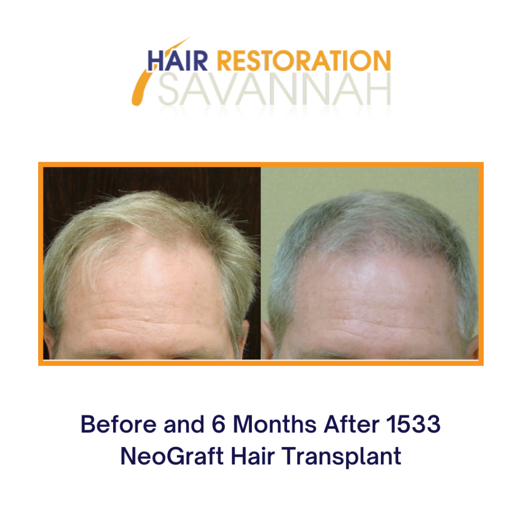 Before and after hair restoration for male hair loss