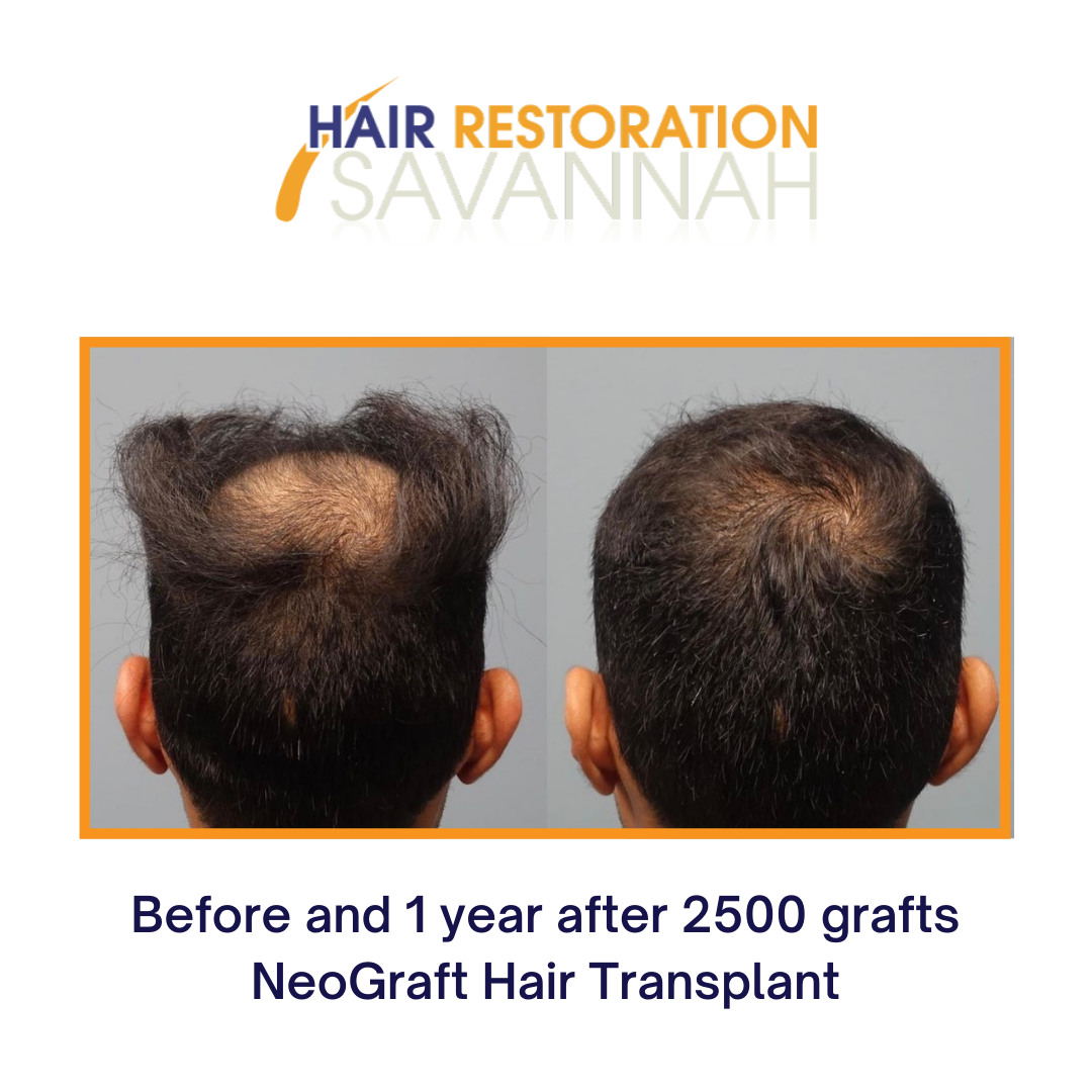 Hair Restoration Cost | Hair Restoration Savannah FUT and FUE Method