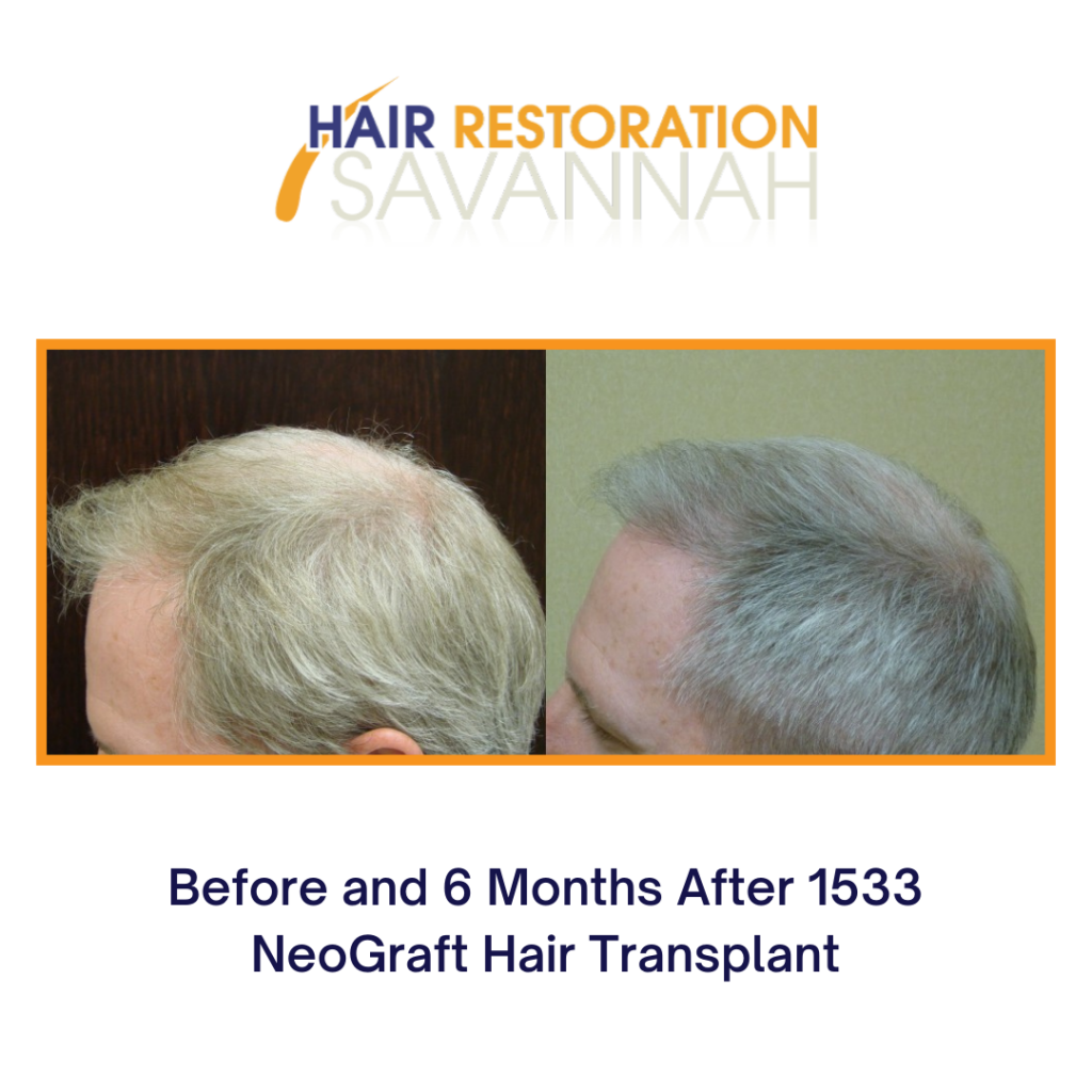 before and after hair restoration for male hair loss