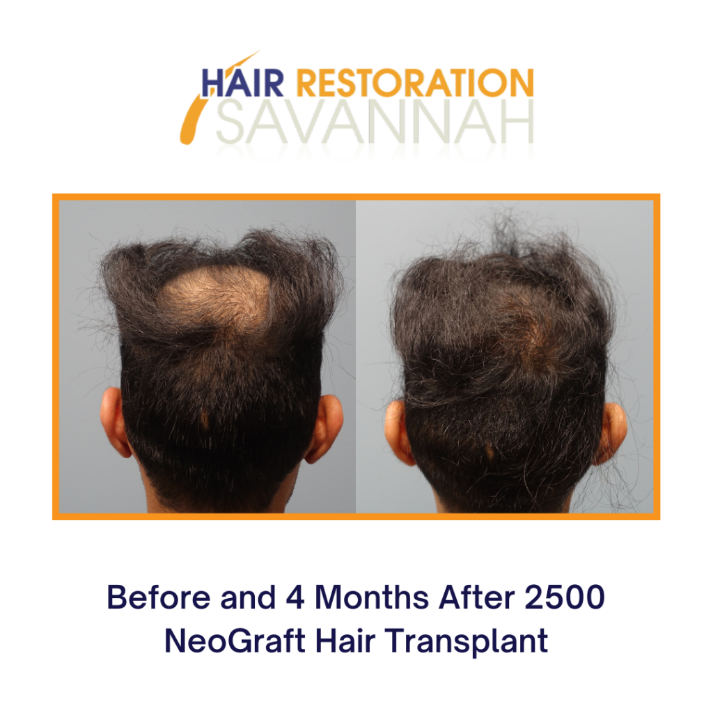 13 PRP Therapy and Neograft before and after results