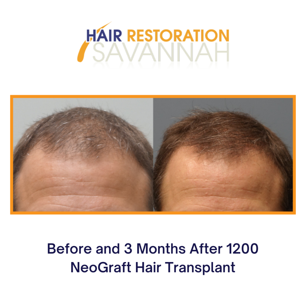 before and after hair restoration for male hair loss