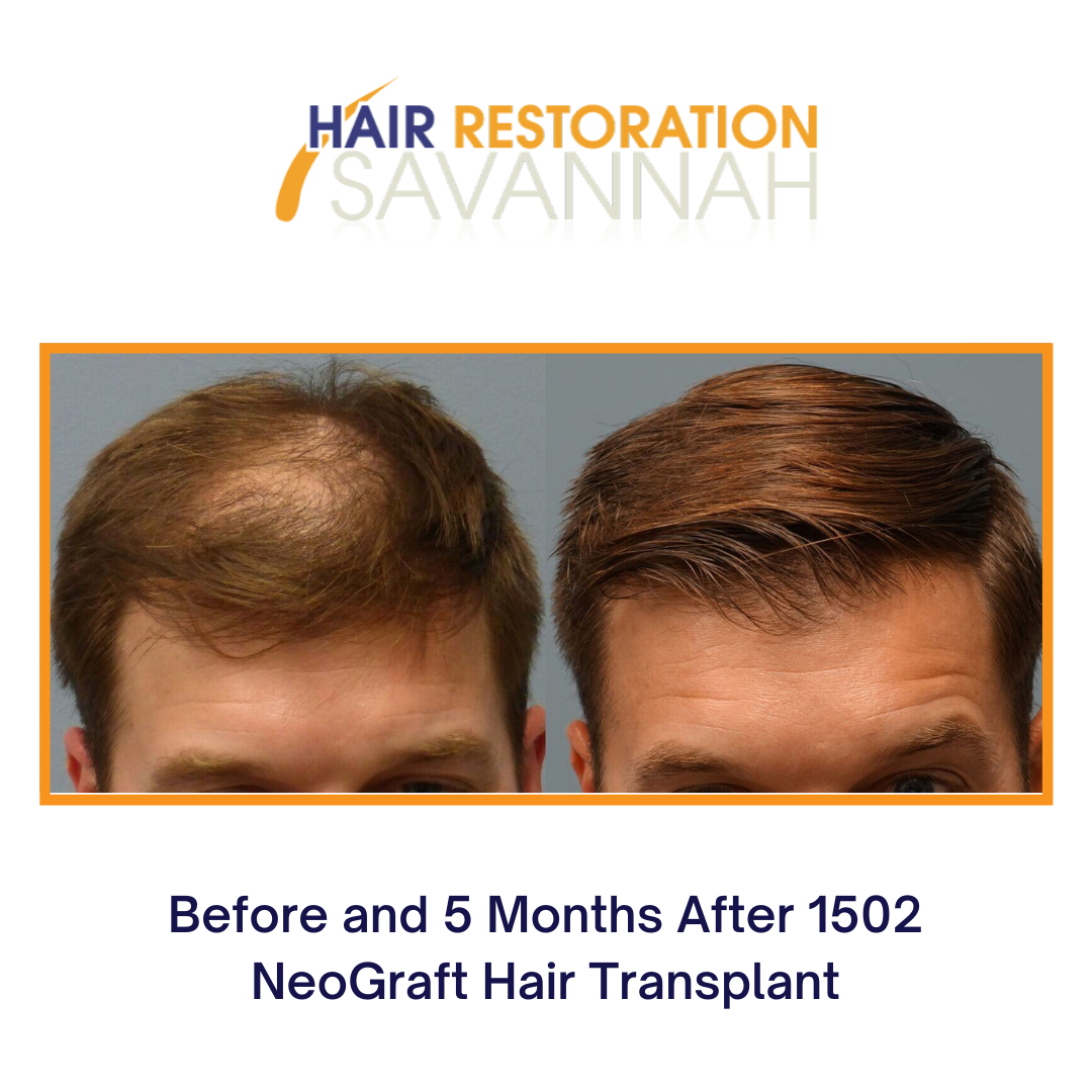 Before and After 1502 NeoGraft Hair Transplant