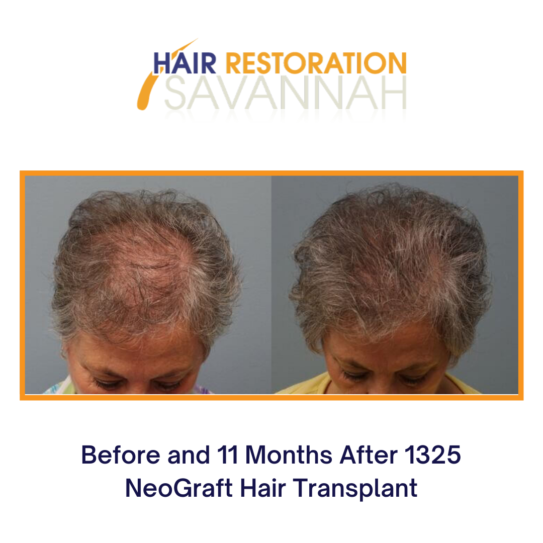 Female HAIR LOSS Before and after Neograft Hair Transplant 1325 grafts