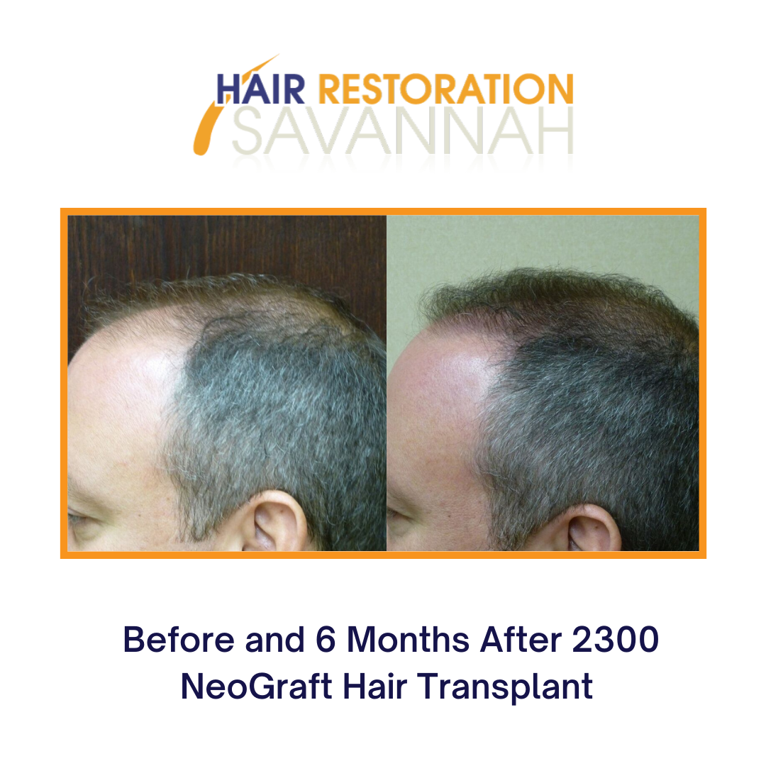 Before and 6 Months after 2300 NeoGraft Hair Transplant