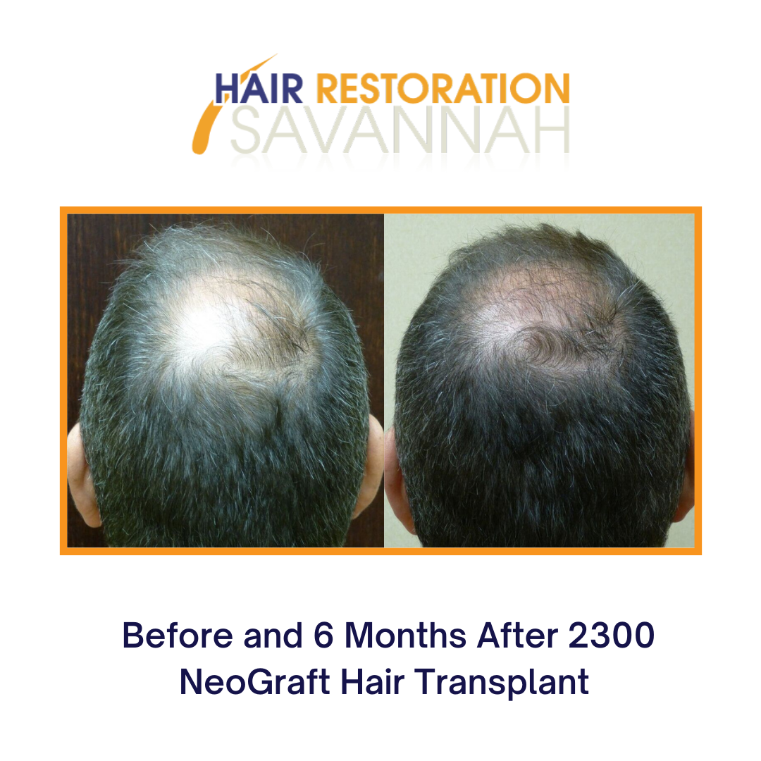 Before and 6 Months after 2300 NeoGraft Hair Transplant