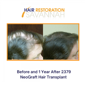Before and 1 year after 2379 NeoGraft Hair Transplant