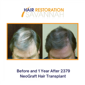 Before and 1 Year After 2379 NeoGraft Hair Transplant