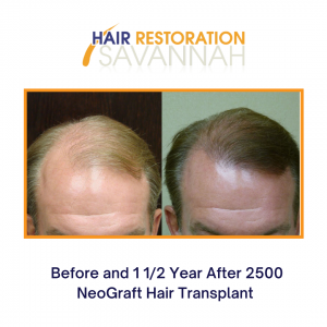 Before and After 2500 NeoGraft Hair Transplant
