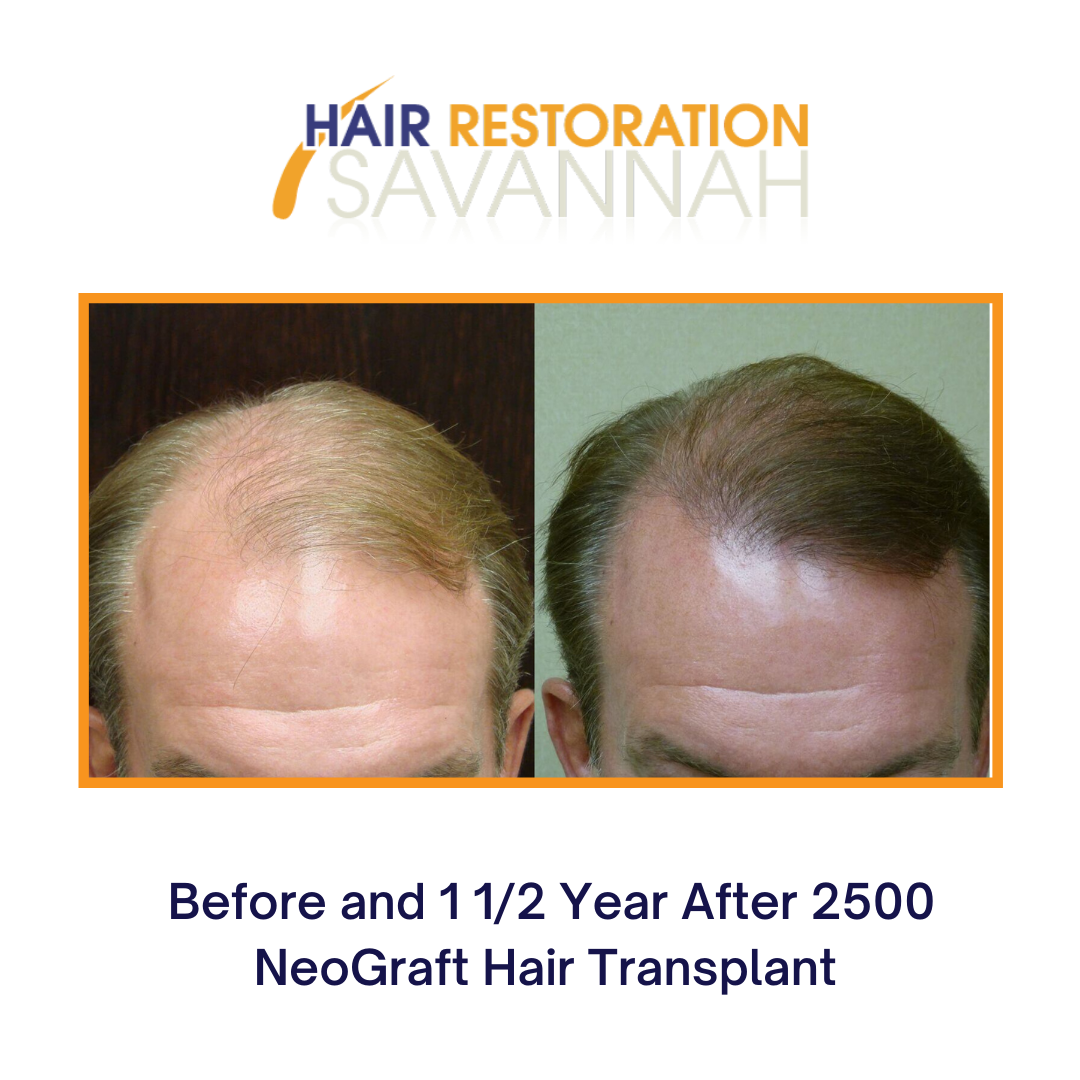 Before and After 2500 NeoGraft Hair Transplant Before and After 2500 NeoGraft Hair Transplant