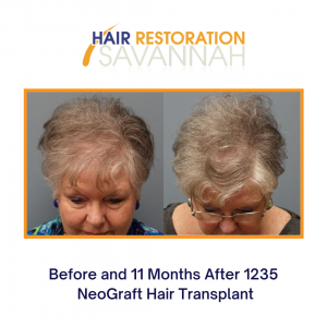 Before and After 1235 NeoGraft Hair Transplant