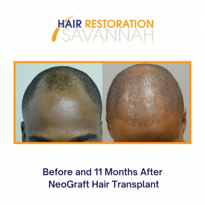 Before and 11 Months After NeoGraft Hair Transplant