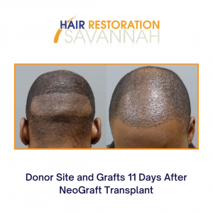 Donor Site and Grafts 11 Days After NeoGraft Transplant