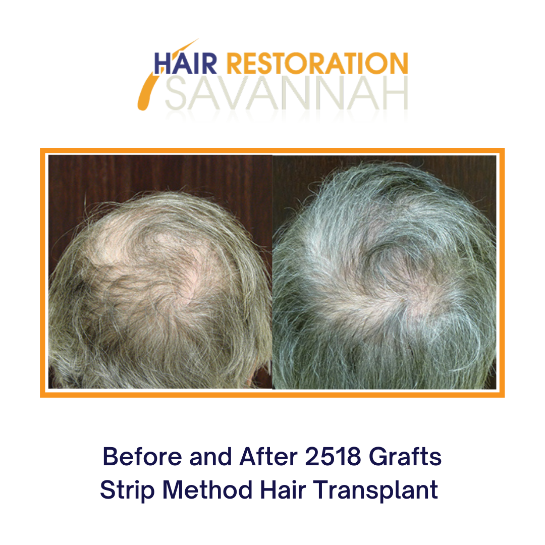Before and after strip method of hair restoration