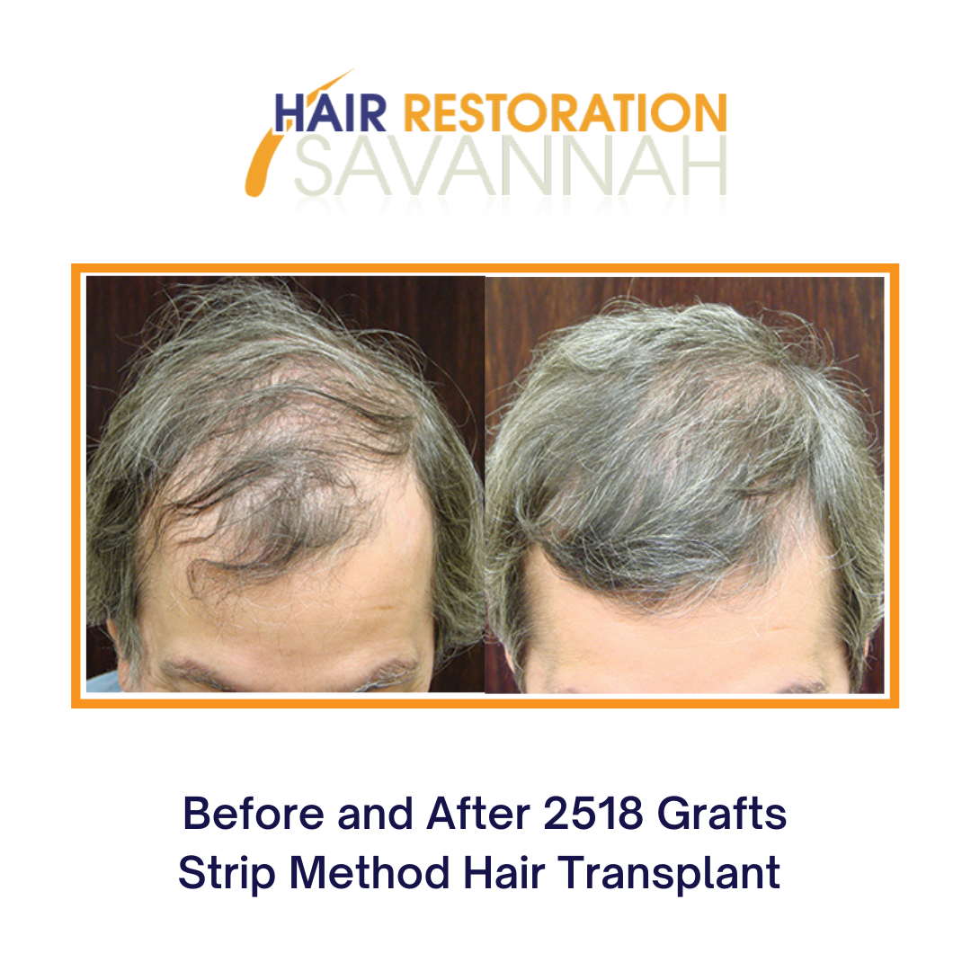 Before and after hair restoration for male hair loss