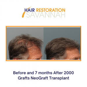 Before and after 7-months Neograft Hair Transplant 2000 grafts