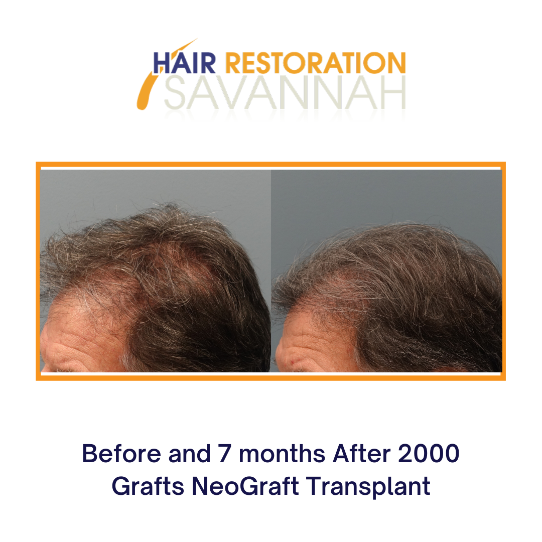 Before and after 7-months Neograft Hair Transplant 2000 grafts - Hair  Restoration Savannah