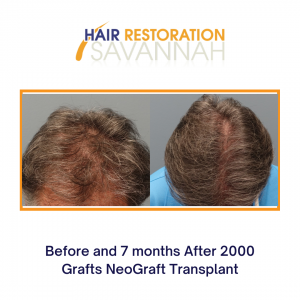 Before and after HAIR RESTORATION