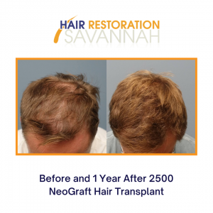 Before and after 1 year with Neograft Hair Restoration