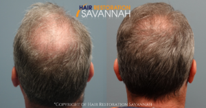 Before and After 2500 Neograt Hair Transplant- Hair Restoration Savannah