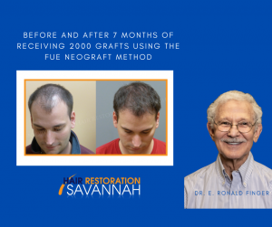 Before and After 7 Months of receiving 2000 Grafts FUE Neograft Method