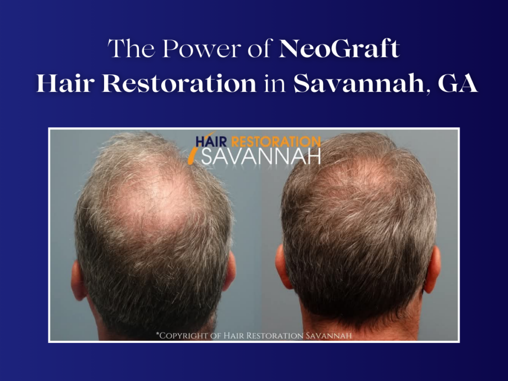 Hair Restoration Savannah- The Power of NeoGraft Hair Restoration in Savannah, GA Hair-Restoration-Savannah-The-Power-of-NeoGraft-Hair-Restoration-in-Savannah