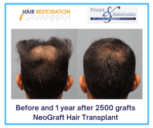 Before and 1 year after 2500 grafts NeoGraft Hair Transplant