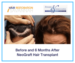Before and 6 Months After NeoGraft Transplant